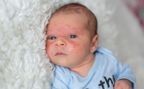 了解的有关婴儿痤疮粟粒疹和斑点皮肤的知识